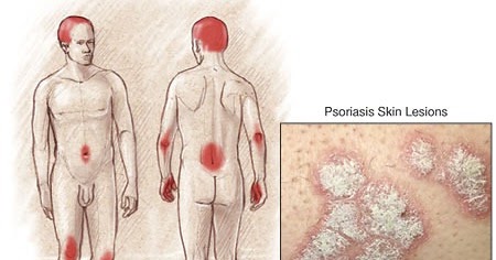 La cocción de la celidonia mayor a la psoriasis de la cabeza